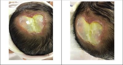 Case report: Aplasia cutis congenita of the scalp with bone defect and an exposed sagittal sinus in a trisomy 13 newborn